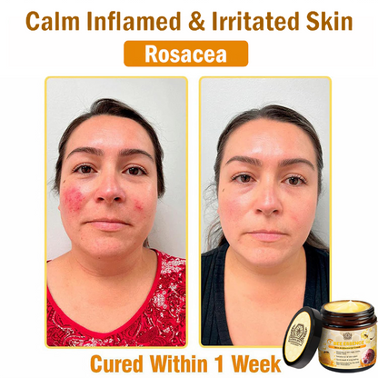 Dermavell™ Bee Essence Skin Antibacterial Cream—used to treat a variety of skin diseases (AAD recommended)