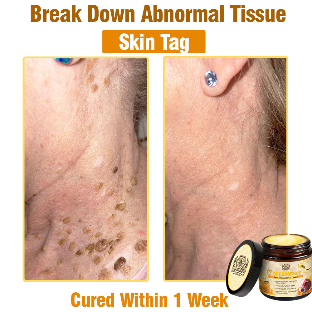 Dermavell™ Bee Essence Skin Antibacterial Cream—used to treat a variety of skin diseases (AAD recommended)