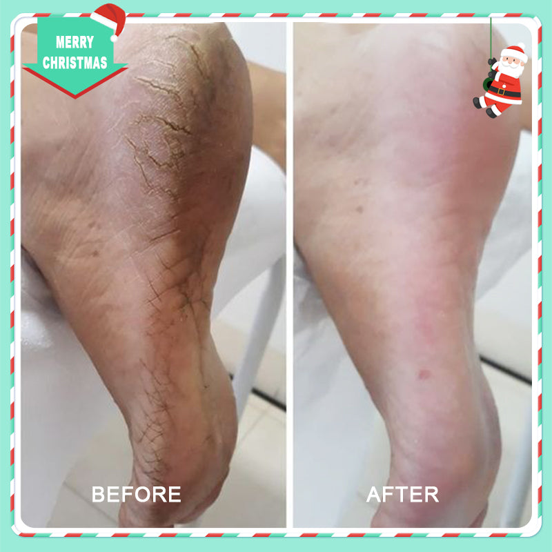 42% Urea Moisturizing Exfoliating Cream