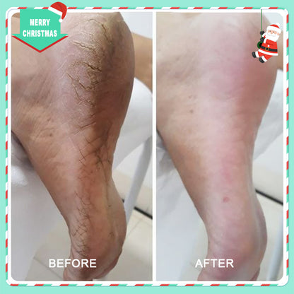 42% Urea Moisturizing Exfoliating Cream