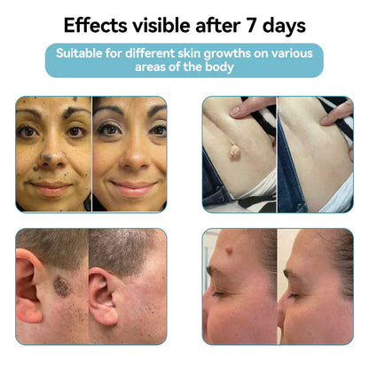 ✨Glossy™ All-in-One CO₂ Laser Eraser Pen | Removes Moles, Warts, Skin Flaws & Pigmentation