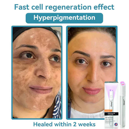 ✨Glossy™ All-in-One CO₂ Laser Eraser Pen | Removes Moles, Warts, Skin Flaws & Pigmentation