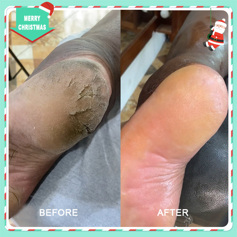 42% Urea Moisturizing Exfoliating Cream