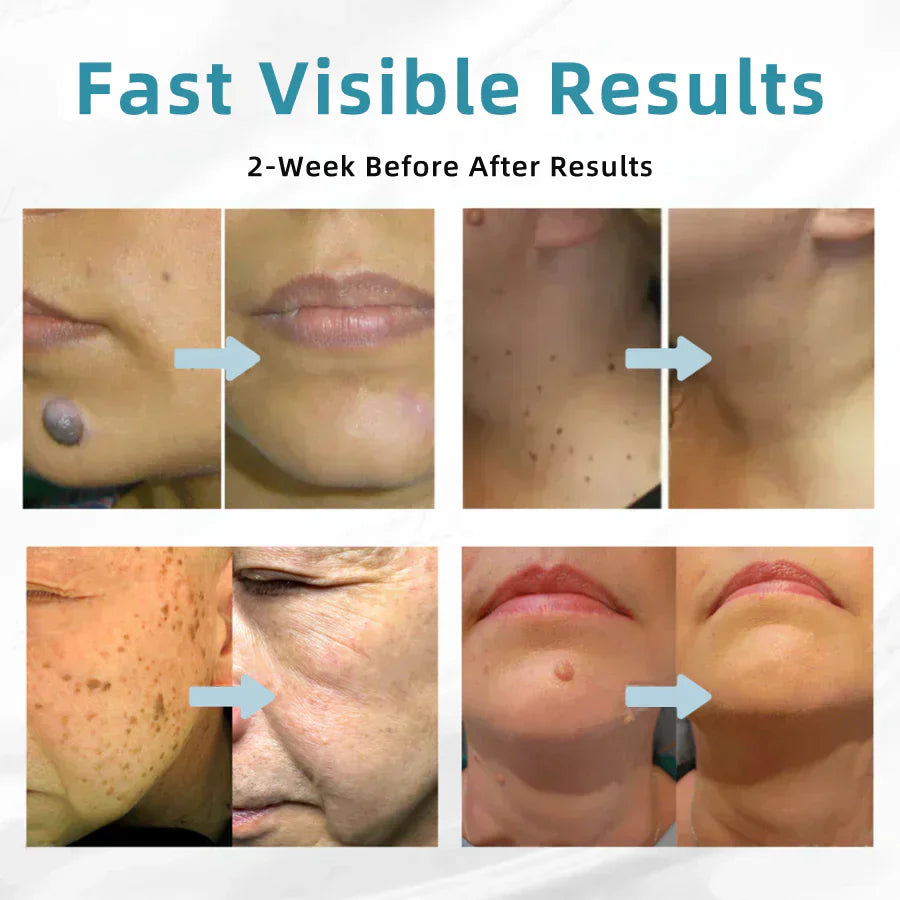 ✨Glossy™ All-in-One CO₂ Laser Eraser Pen | Removes Moles, Warts, Skin Flaws & Pigmentation