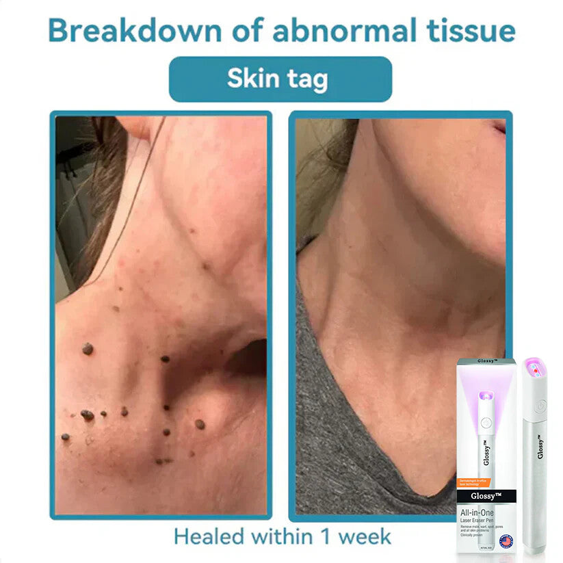 ✨Glossy™ All-in-One CO₂ Laser Eraser Pen | Removes Moles, Warts, Skin Flaws & Pigmentation