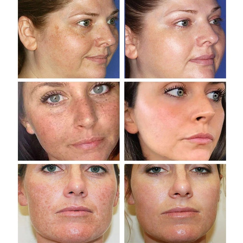 [Official Store] Bikenda™ Blemish Removing Beauty Cream – Fades Dark Spots, Freckles & Wrinkles | Age-Defying, Even-Tone Treatment